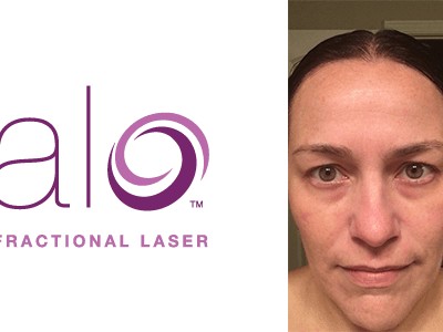 Is Halo Laser Treatment Worth It? Yes! My Experience with Halo by Sciton